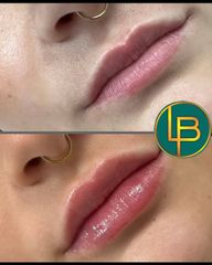 Clínica Dra. Leila Bidaki - Aumento de labios