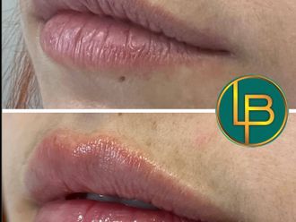Aumento labios antes y después - 875636