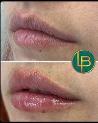 Clínica Dra. Leila Bidaki - Aumento de labios