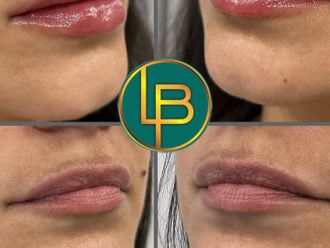 Aumento labios antes y después - 875637