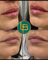 Clínica Dra. Leila Bidaki - Aumento de labios