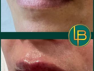 Aumento labios antes y después - 875638