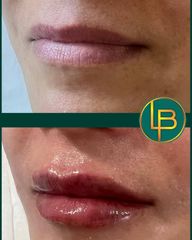 Clínica Dra. Leila Bidaki - Aumento de labios
