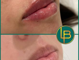 Aumento labios antes y después - 875639