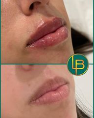 Clínica Dra. Leila Bidaki - Aumento de labios