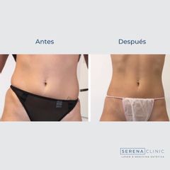 Criolipólisis - Serena Clinic