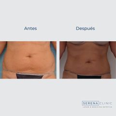 Criolipólisis - Serena Clinic