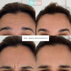 Eliminación de arrugas - Belkovskaya Clínica
