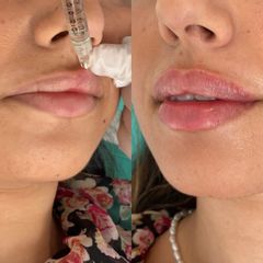 Aumento de labios - Belkovskaya Clínica