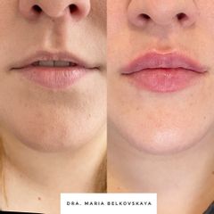 Aumento de labios - Belkovskaya Clínica