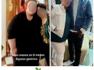 Reducción de estómago antes y después - 813227