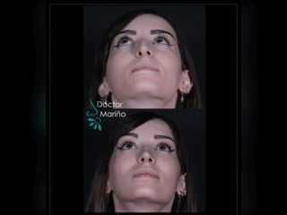 Rinoplastia - Dr. Franklin Mariño Sanchez
