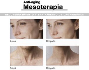 Antes y después mesoterapia 