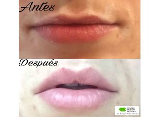 antes y después aumento de labios