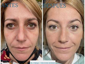 Blefaroplastia sin cirugía - 786219