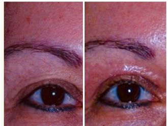 Blefaroplastia sin cirugía - 641665