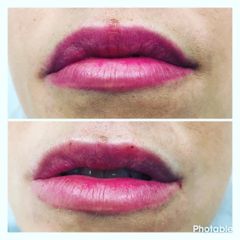 Aumento de labios - Dr. Eduardo De La Rosa
