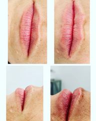 Aumento de labios - Dr. Eduardo De La Rosa