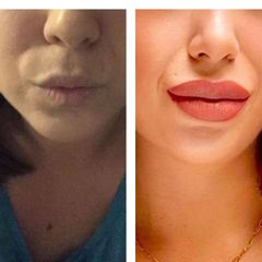 Aumento de labios - Dr. Eduardo De La Rosa