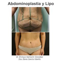 Abdominoplastia - Dr. Enrique Salmerón González
