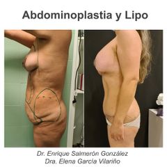 Abdominoplastia - Dr. Enrique Salmerón González