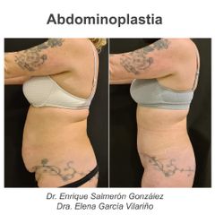 Abdominoplastia - Dr. Enrique Salmerón González