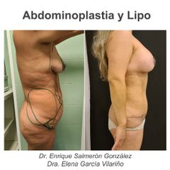Abdominoplastia - Dr. Enrique Salmerón González