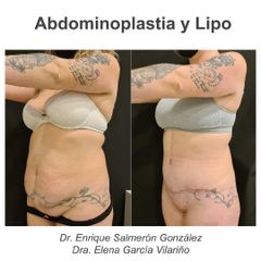 Abdominoplastia - Dr. Enrique Salmerón González