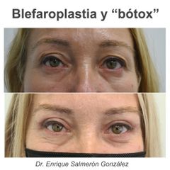 Blefaroplastia - Dr Enrique Salmeron