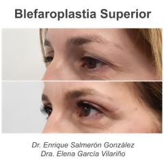 Blefaroplastia - Dr Enrique Salmeron Gonzalez