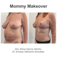 Abdominoplastia - Dr. Enrique Salmeron Gonzalez
