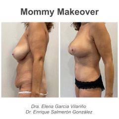 Mommy makeover - Dr. Enrique Salmerón González