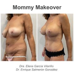 Abdominoplastia - Dr. Enrique Salmeron Gonzalez