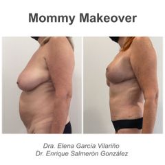 Abdominoplastia - Dr. Enrique Salmeron Gonzalez