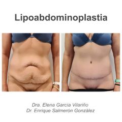 Abdominoplastia - Dr. Enrique Salmeron Gonzalez