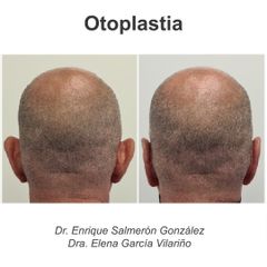 Otoplastia - Dr. Enrique Salmerón González