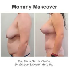 Abdominoplastia - Dr. Enrique Salmeron Gonzalez
