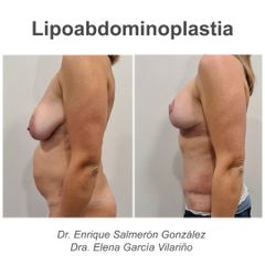 Abdominoplastia - Dr. Enrique Salmerón González