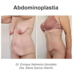 Abdominoplastia - Dr. Enrique Salmerón González