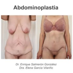 Abdominoplastia - Dr. Enrique Salmeron Gonzalez