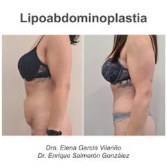 Abdominoplastia - Dr. Enrique Salmeron Gonzalez
