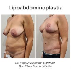 Abdominoplastia - Dr. Enrique Salmerón González