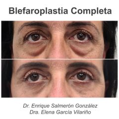 Blefaroplastia - Dr Enrique Salmeron Gonzalez