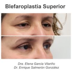 Blefaroplastia - Dr. Enrique Salmerón González