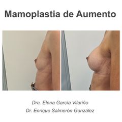 Aumento de pecho  - Dr. Enrique Salmeron