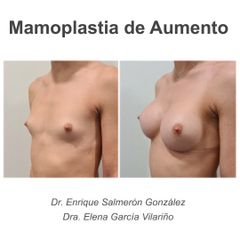 Aumento de pecho - Dr. Enrique Salmeron