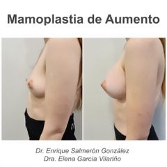 Aumento de pecho - Dr. Enrique Salmeron