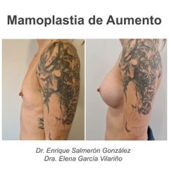 Aumento de pecho - Dr. Enrique Salmeron