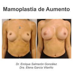Aumento de pecho - Dr. Enrique Salmeron