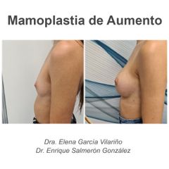 Aumento de pecho - Dr. Enrique Salmeron
